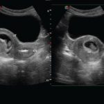 Appareil d'Echographie Tactile pour la gynécologie