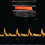 Echographe Tactile Angiologie Doppler TSA