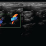 Echographe Tactile pour Angiologues