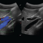 Echographe Tactile pour gastroéntérologues